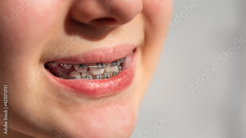 Close up of a teenage girl smiling in orthodontic brackets. Girl with braces on teeth.