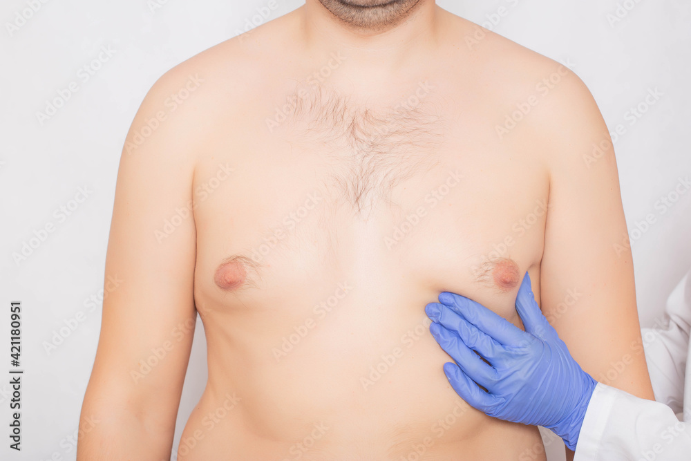 Plastic surgeon doctor examines the male breast before surgery to reduce breast fat, gynecomastia Plastic surgeon doctor examines the male breast before surgery to reduce breast fat, gynecomastia