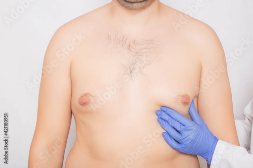 Plastic surgeon doctor examines the male breast before surgery to reduce breast fat, gynecomastia