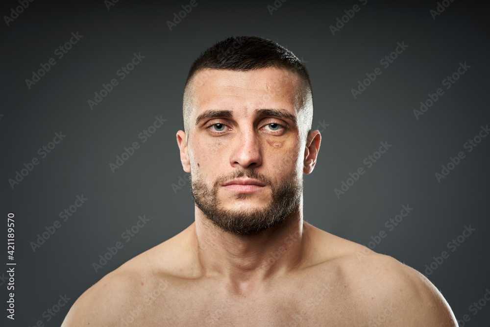 Fototapeta premium Bruised fighter on gray background