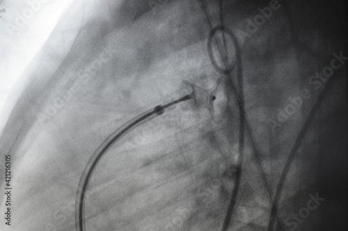 x ray image perform PDA device closure after treatment patent ductus arteriosus disease (PDA), which is congenital heart disease photo