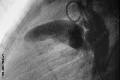 pediatric angiography. Aortography showed patent ductus arteriosus (PDA), which is congenital heart disease, in cardiac catheterization room.	 photo