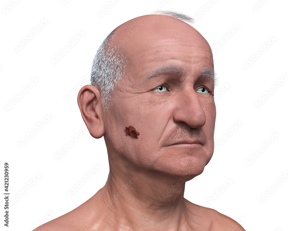 Melanoma on face skin, computer illustration Melanoma on face skin, computer illustration