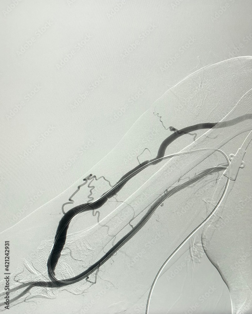 Angiogram of hemodialysis arteriovenous fistula (AVF) during Endovascular intervention in end stage renal disease (ESRD) patient.