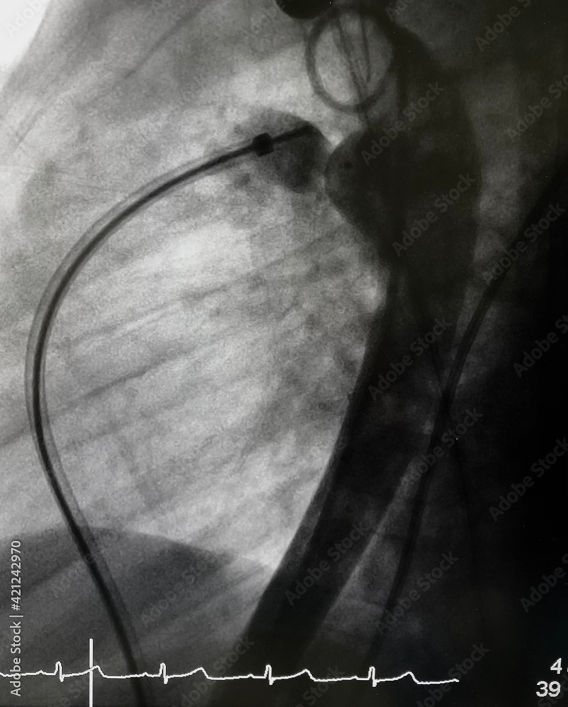 Aortography showed patent ductus arteriosus (PDA) during PDA closure