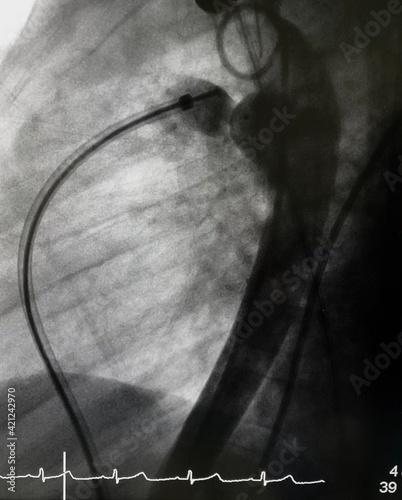 Aortography showed patent ductus arteriosus (PDA) during PDA closure device via endovascular procedure. photo