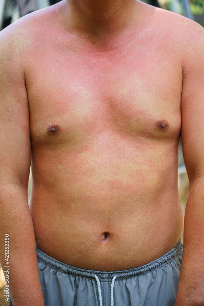 Man adult onset food allergy have had a severe reaction emergency care confirmed diagnosis Itchy rash, suffocate, faint and feverish With symptoms on legs, arms, torso, abdomen, back, face, neck body. Man adult onset food allergy have had a severe reaction emergency care confirmed diagnosis Itchy rash, suffocate, faint and feverish With symptoms on legs, arms, torso, abdomen, back, face, neck body.
