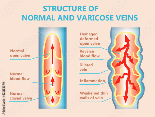 The varicose veins and normal veins