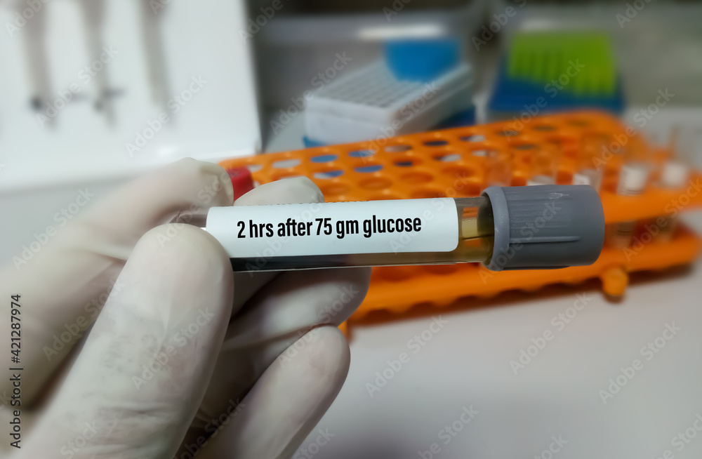 Technician or scientist hold a sample tube of Oral Glucose Tolerance