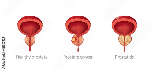 Stages growth prostatitis and tumors. Pathological disruption of male gland with enlarged into malignant genital impaired reproductive function blockage urethra vector.