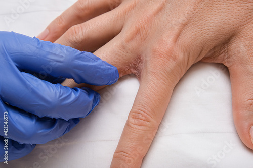A doctor dermatologist examines patients hand with interdigital dermatitis, dyshidrotic eczema on hand