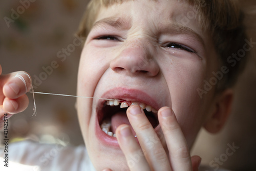 Close up of little kid with open mouth. boy who is trying to tear up his milk tooth by thread. Feeling of pain and fear.