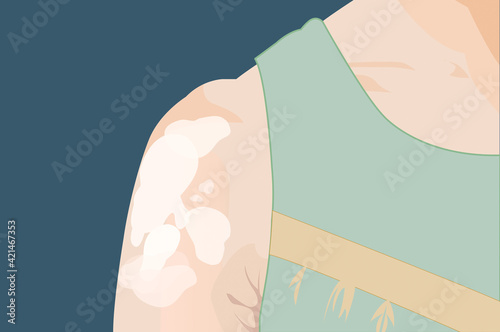 Close up vitiligo skin problems on woman arm and shoulder illustration