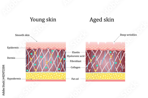 Vector illustration of age-related changes in the skin. Comparison of young and old skin. Structure human skin with collagen and elastin fibers, fibroblasts. photo