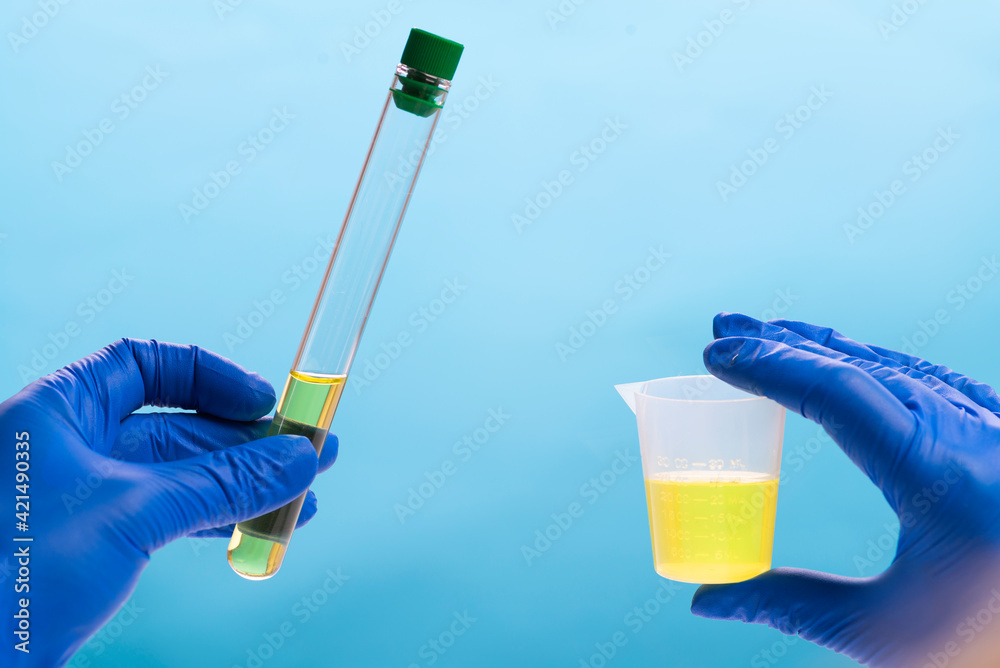 Urine analysis in the laboratory. Medical urine test. Urine sample for laboratory analysis Stock