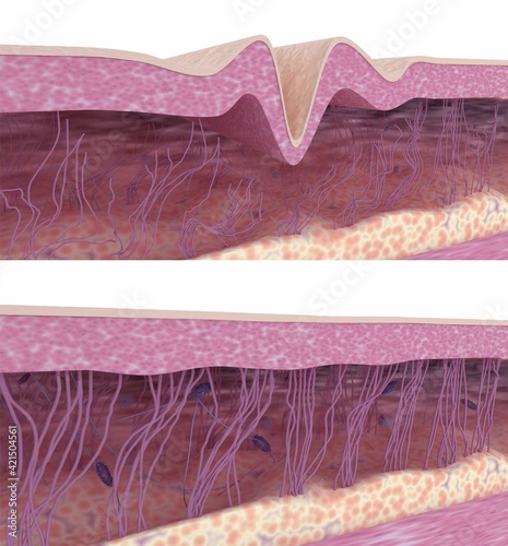 Wrinkled skin before and after skin rejuvenation treatment. Skin tissue, collagen, elastin fibers, fibroblasts, hyaluronic cells in cross-section view. Simile of young and aging skin. 3D illustration. photo