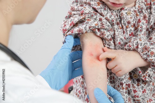 Doctor looking at red and itchy eczema on little girl's arm. Toddler girl suffering from atopic dermatitis. photo