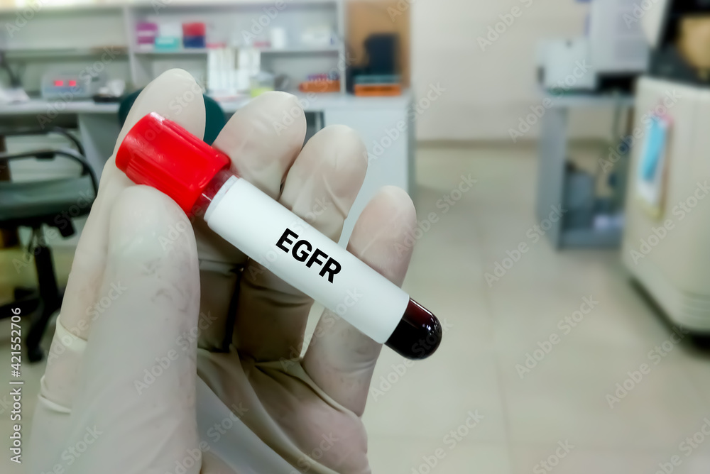 Blood sample for eGFR test, Creatinine, Bun. Closeup. Stock Photo