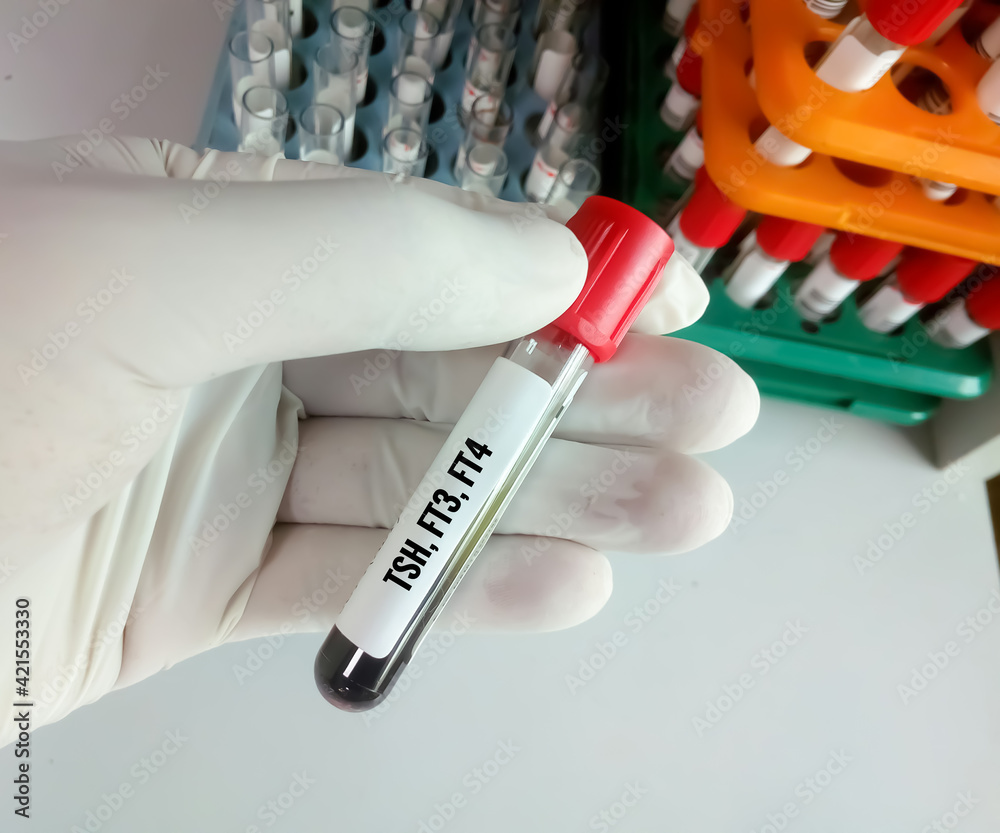 Blood sample in test tubes for hormonal examination of thyroid gland in