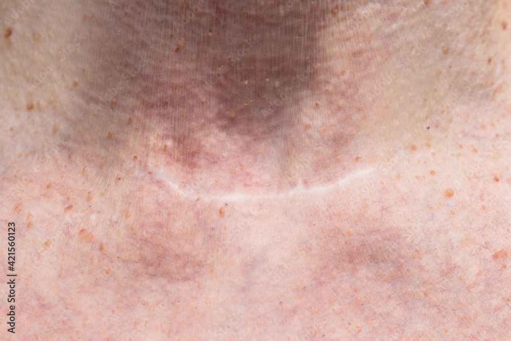 Scar from thyroid removal surgery due to cancer. Conservative method of surgery. Close up.