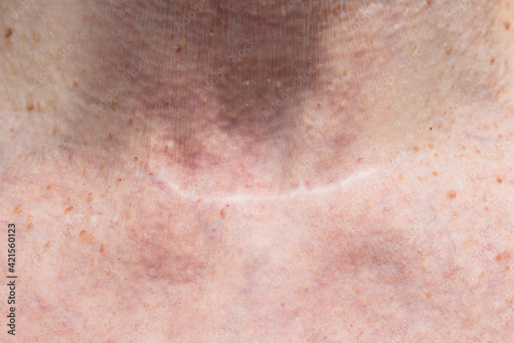 Fototapeta premium Scar from thyroid removal surgery due to cancer. Conservative method of surgery. Close up.