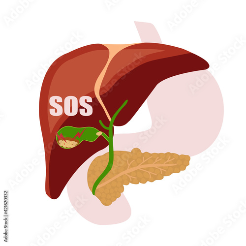 Gallstones. A fit of pain. Digestive organs. Liver, pancreas, gallbladder.Vector.