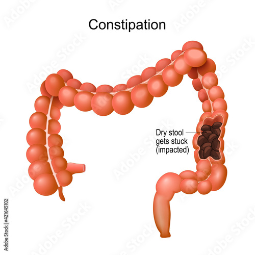 Constipation.  large intestine.