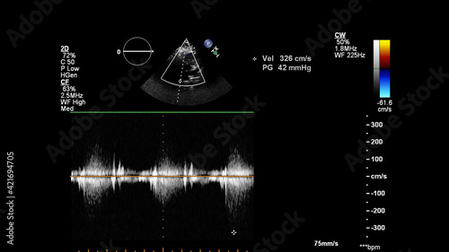 Image of the heart during transesophageal ultrasound with Doppler mode.