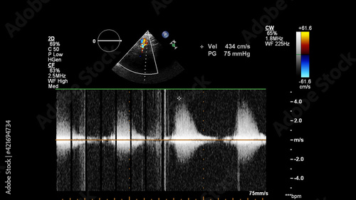 Image of the heart during transesophageal ultrasound with Doppler mode.