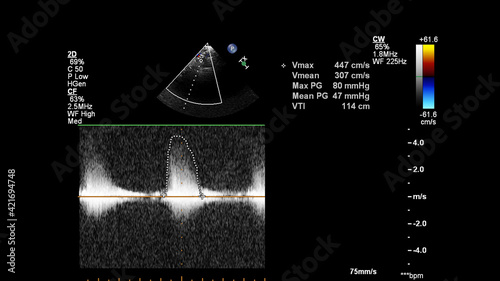 Image of the heart during transesophageal ultrasound with Doppler mode.