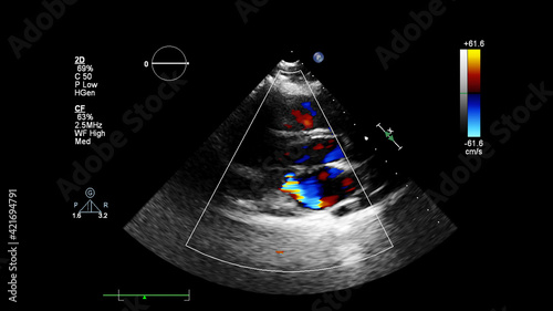 Image of the heart during transesophageal ultrasound with Doppler mode.