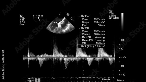 Image of the heart in gray-scale mode during transesophageal ultrasound.