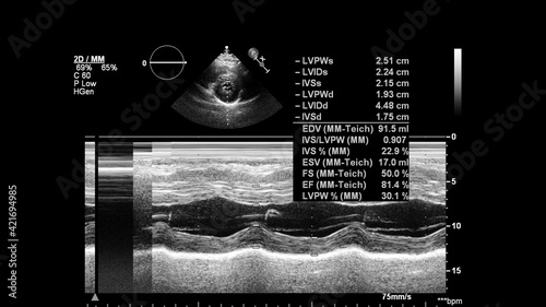 Image of the heart in gray-scale mode during transesophageal ultrasound.