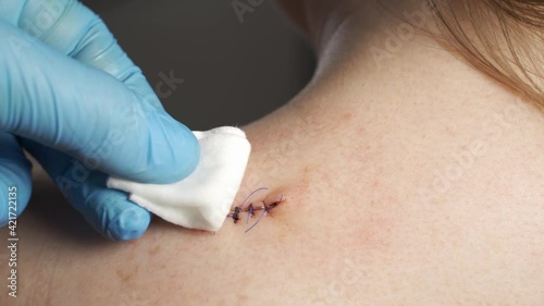 Doctor cleaning shoulder wound with cotton ball and dressing set, wound care process.