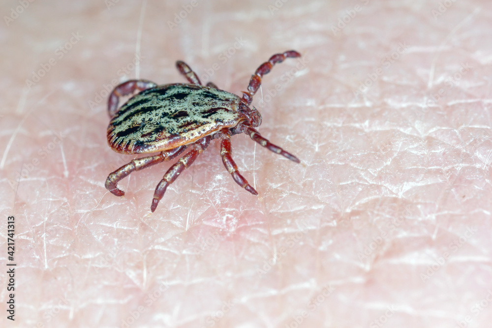 Lyme disease-carrier Ixodes tick Dermacentor marginatus on human skin.
