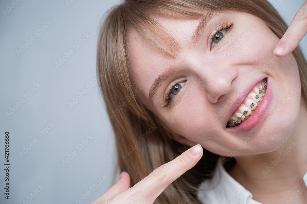 A beautiful red-haired girl smiles and points to the braces. Young woman corrects bite with orthodontic appliance A beautiful red-haired girl smiles and points to the braces. Young woman corrects bite with orthodontic appliance