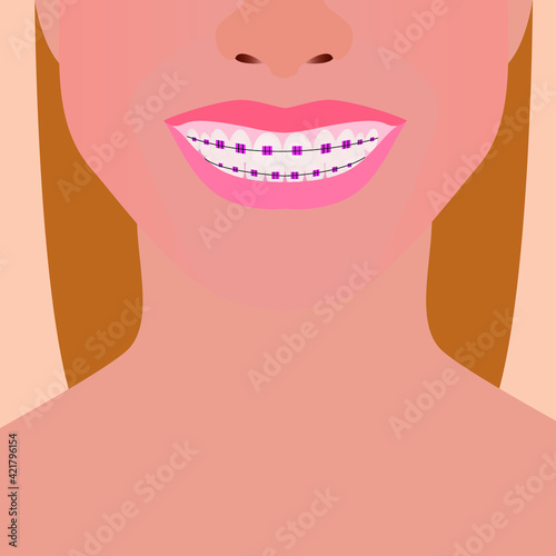 Healthy teeth with braces. Close-up smile.
