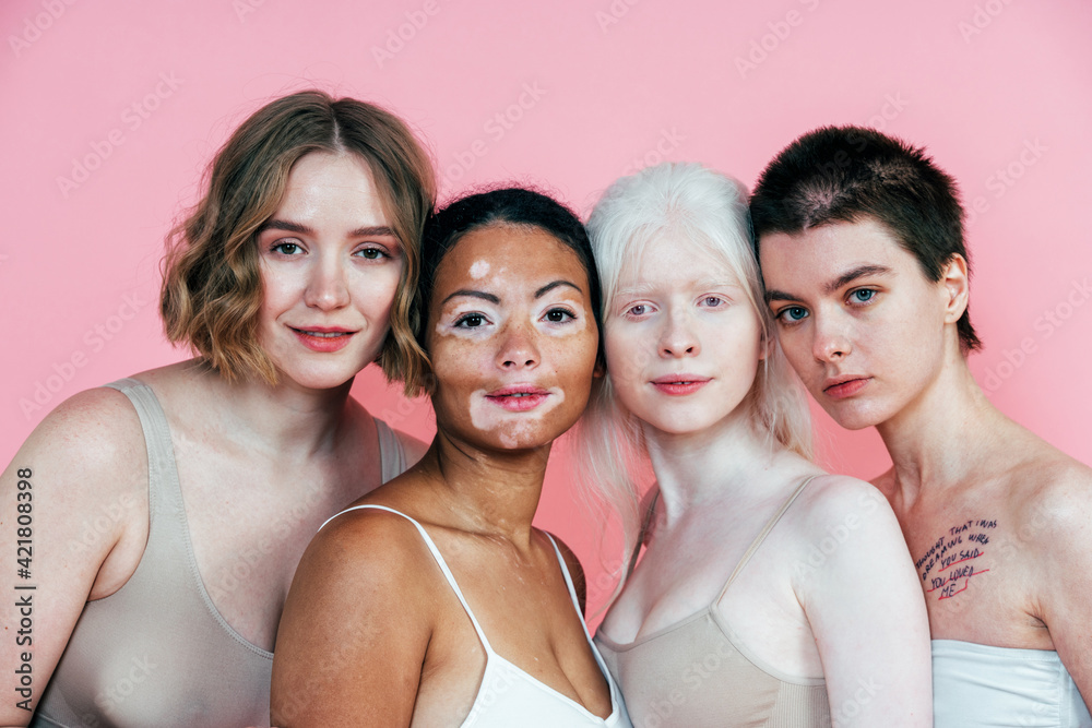 Group of multiethnic women with different kind of skin posing together in studio. Concept about body positivity and self acceptance