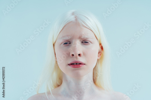 Beauty image of an albino girl posing in studio wearing lingerie. Concept about body positivity, diversity, and fashion photo