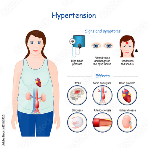 Hypertension. Signs, symptoms, and Effects of High blood pressure.