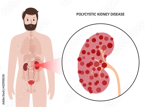 Kidney disease concept