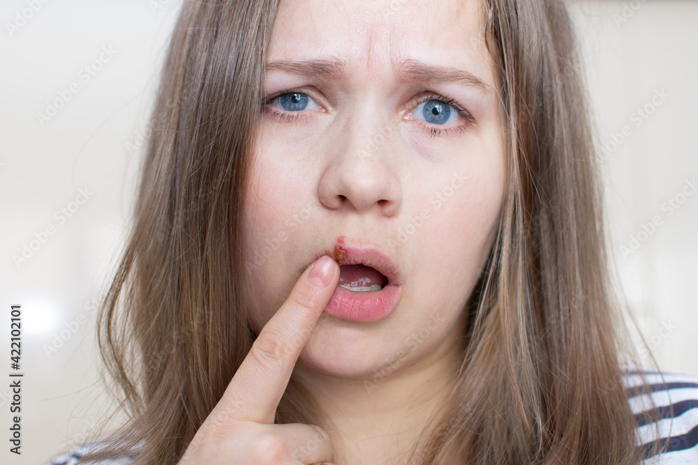 Virus herpes on the lips of a girl. Young woman with herpis virus on her lip, touching her lip with her finger. Virus herpes on the lips of a girl. Young woman with herpis virus on her lip, touching her lip with her finger.