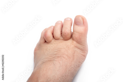 studio lighting. a human leg on a white background. The finger is strongly curved, deformed. Close-up. © sir270