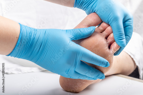 studio lighting. a human leg on a white background. A doctor in blue gloves examines the legs with a fungal infection of the leg. Close-up