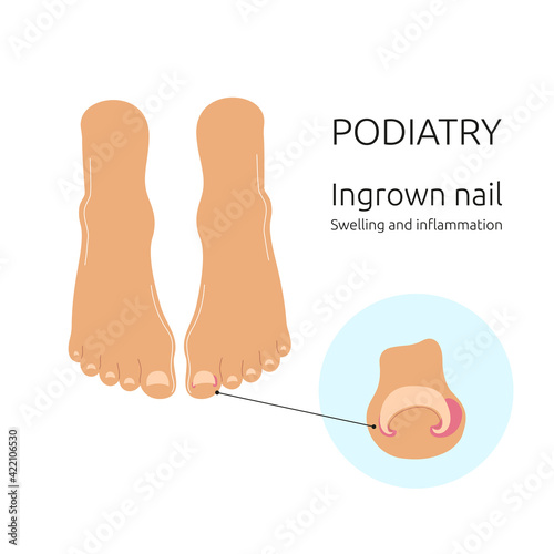 Feet and ingrown toenail. Orthopedics. Vector isolated on white background.