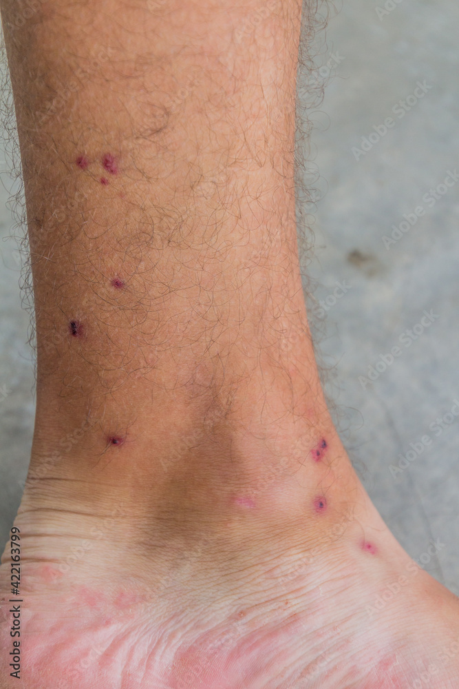 Fototapeta premium Human leg bitten by leeches