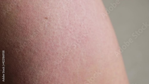 Close up anti-cellulite dry brush massage of real woman skin with stretch marks on buttocks.