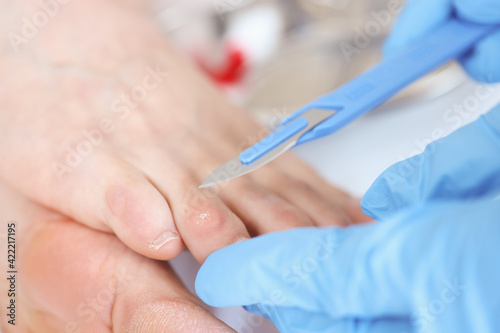 Doctor removes callus with scalpel. Podiatry medical services