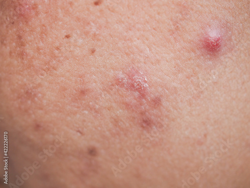 Closeup skin acne texture background.