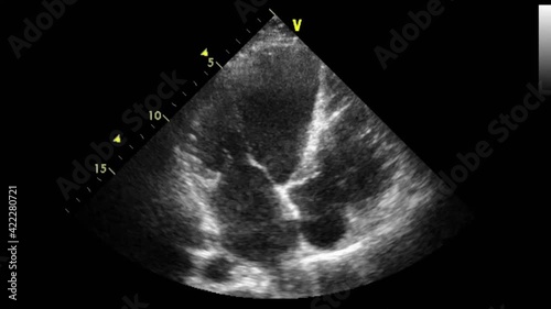 Transesophageal ultrasound video in gray-scale mode.